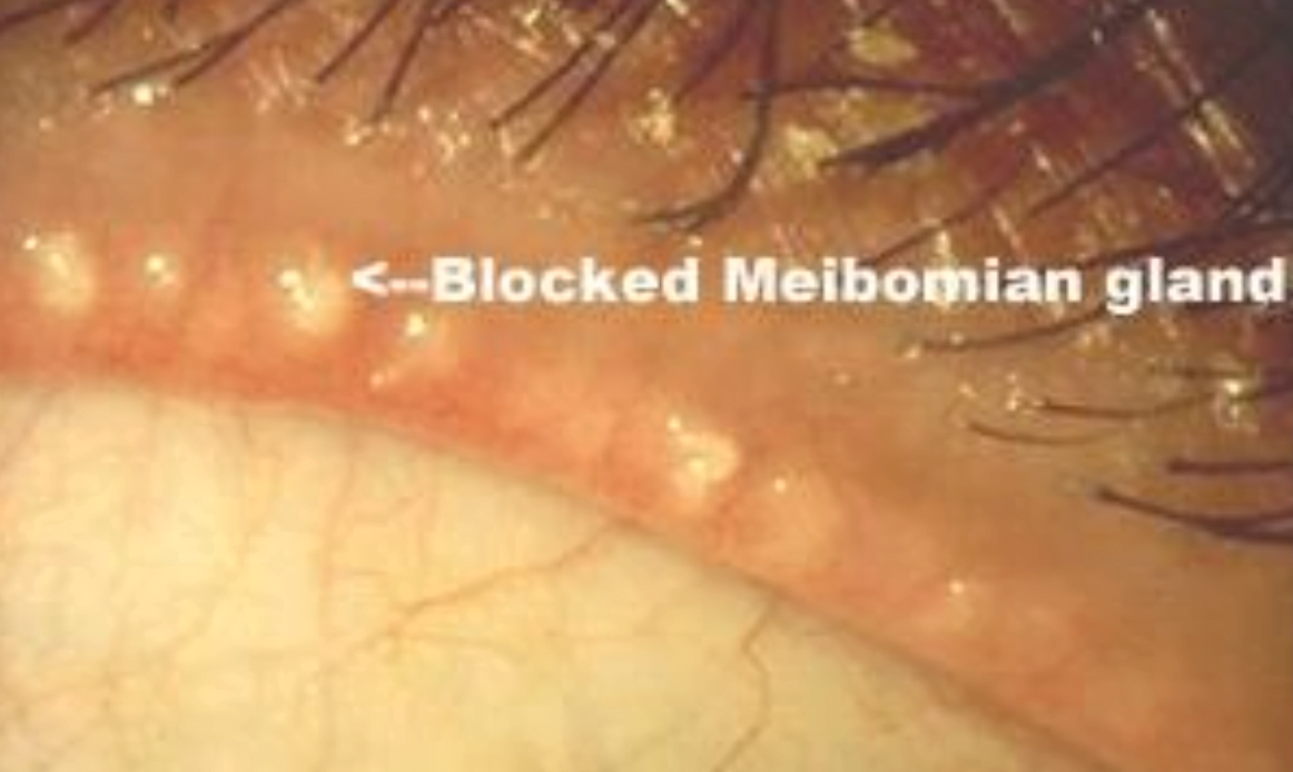 Dry Eye Solutions Southland Eye Clinic